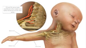 شلل الضفيرة العصبية