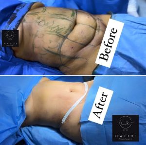 افضل دكتور تجميل لنحت الجسم في مصر