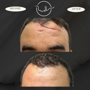 تجميل جروح الوجه