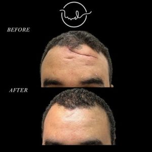 تجميل جروح الوجه بالمنظار